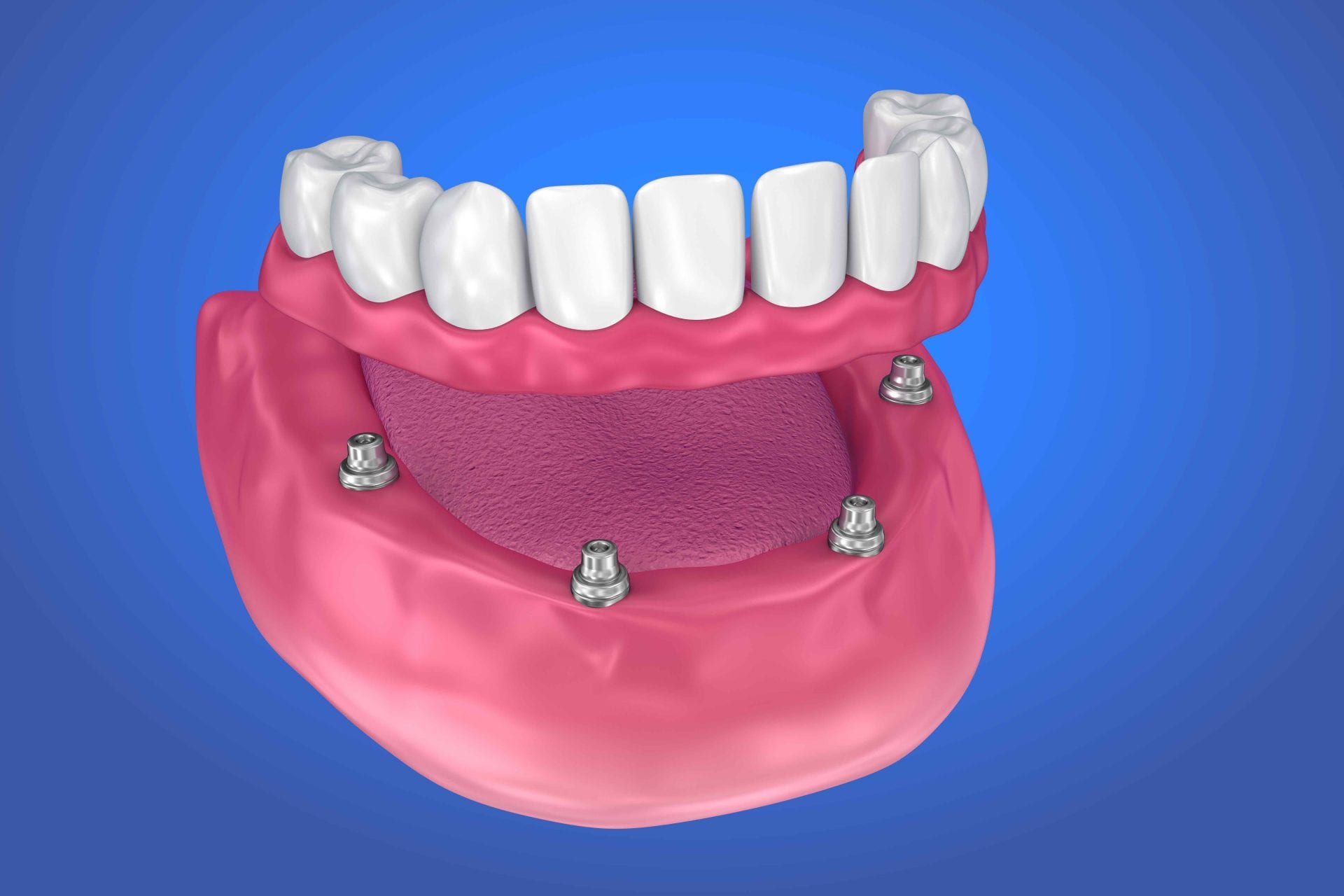 implant supported denture Best Dentist in Lubbock, TX Top Rated Lubbock Dentist Teeth Whitening Lubbock Dr. P’Jay Merrell Dr. Kathleen Nichols Merrell and Nichols Dentistry General, Cosmetic, Restorative, Preventative Family Dentist in Lubbock, TX 79423 porcelain veneers merrell dental Dr. P'jay Merrel top Rated Prosthodontist in Lubbock Texas Dr. Kathleen Nichols Best Prosthodontist in Lubbock services contact us